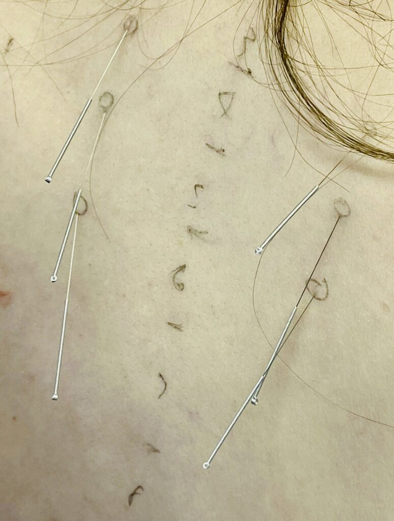 Acupuncture treatment.