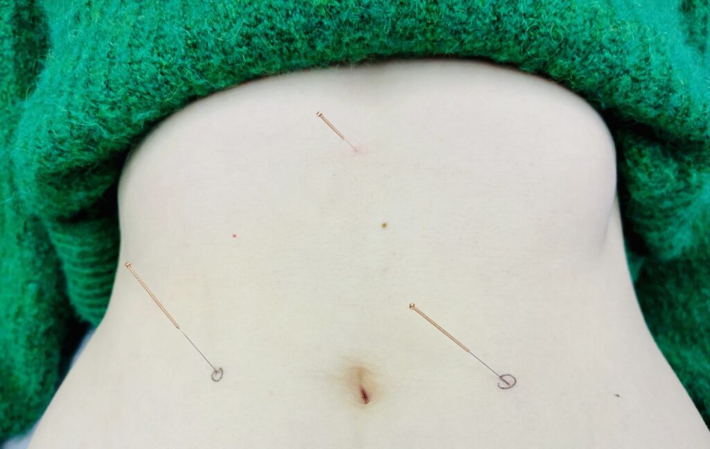Acupuncture treatment.
